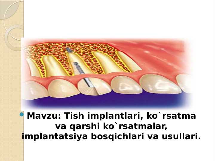 Tish implantlari, ko`rsatma va qarshi ko`rsatmalar, implantatsiya bosqichlari va usullari