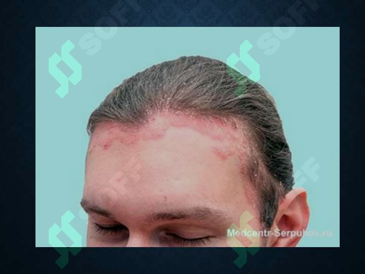 Seboreya vapushti husnbuzar