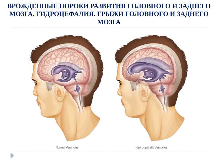 ВРОЖДЕННЫЕ ПОРОКИ РАЗВИТИЯ ГОЛОВНОГО И ЗАДНЕГО МОЗГА. ГИДРОЦЕФАЛИЯ. ГРЫЖИ ГОЛОВНОГО И ЗАДНЕГО МОЗГА