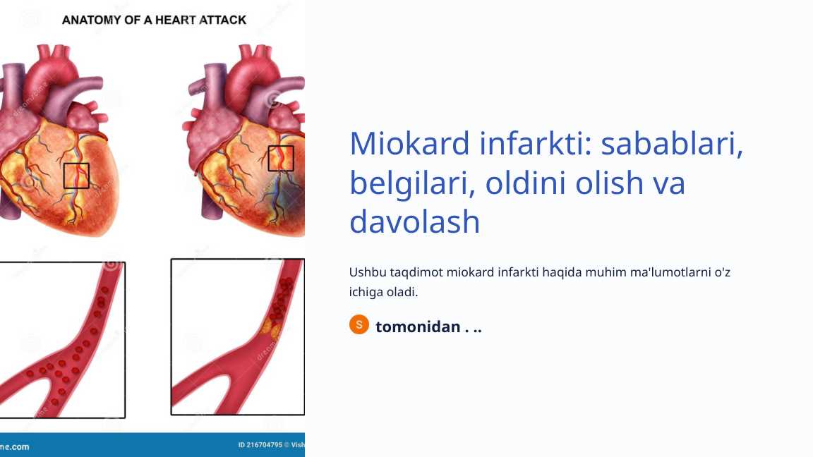 Miokard infarkti sabablari, belgilari, oldini olish va davolash