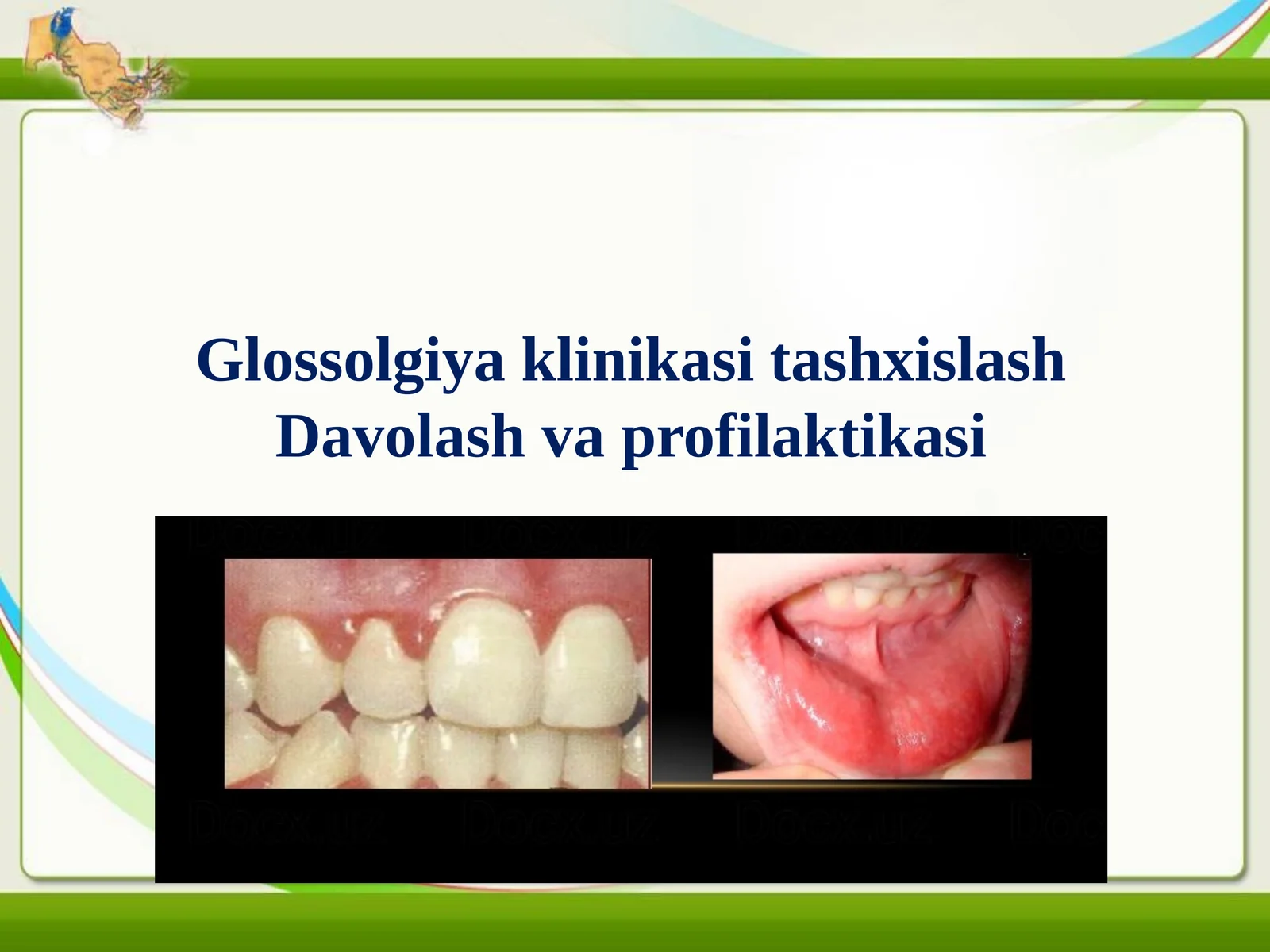 Glossalgiya tashxislash klinikasi.Davolash metodikasi.