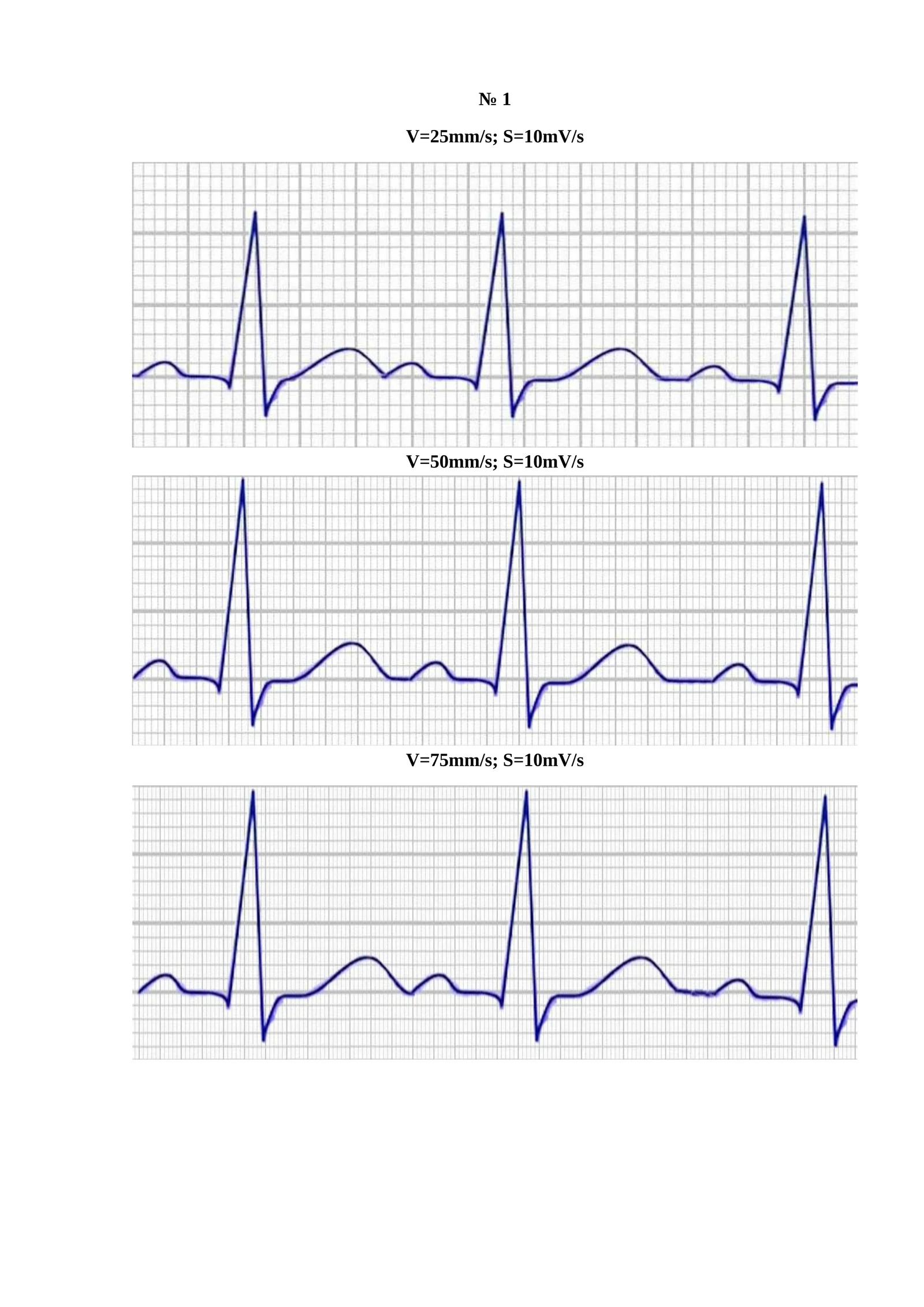 V=25mm/s; S=10mV/s