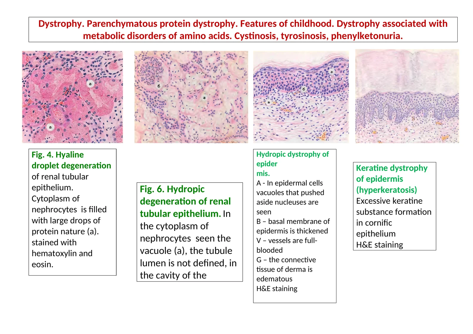 Hydropic dystrophy of epidermis