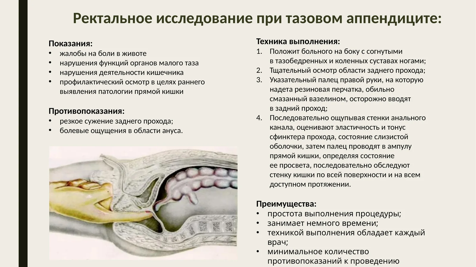 Ректальное исследование при тазовом аппендиците
