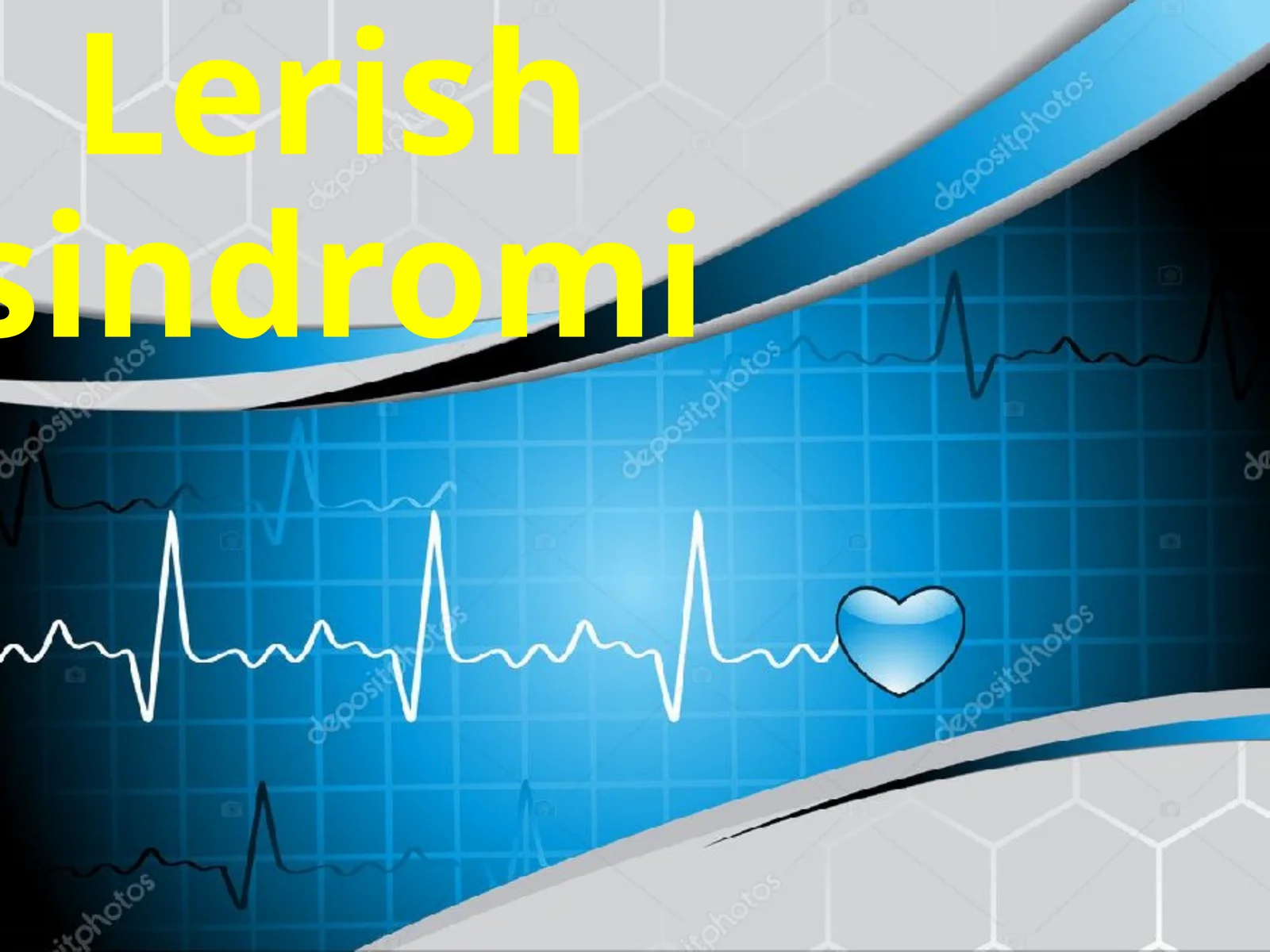 Lerishsindromi