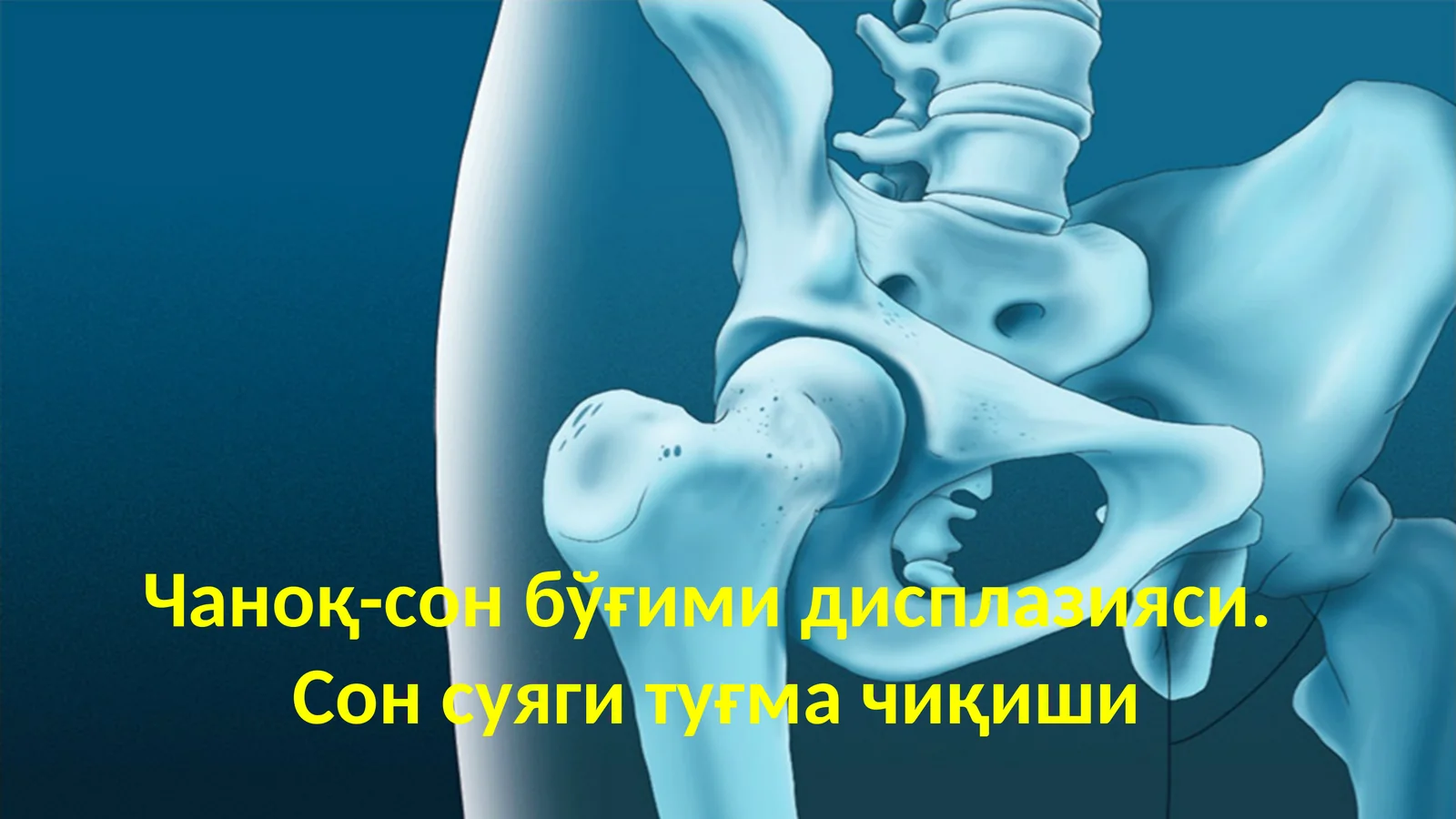 Чаноқ-сон бўғими дисплазияси