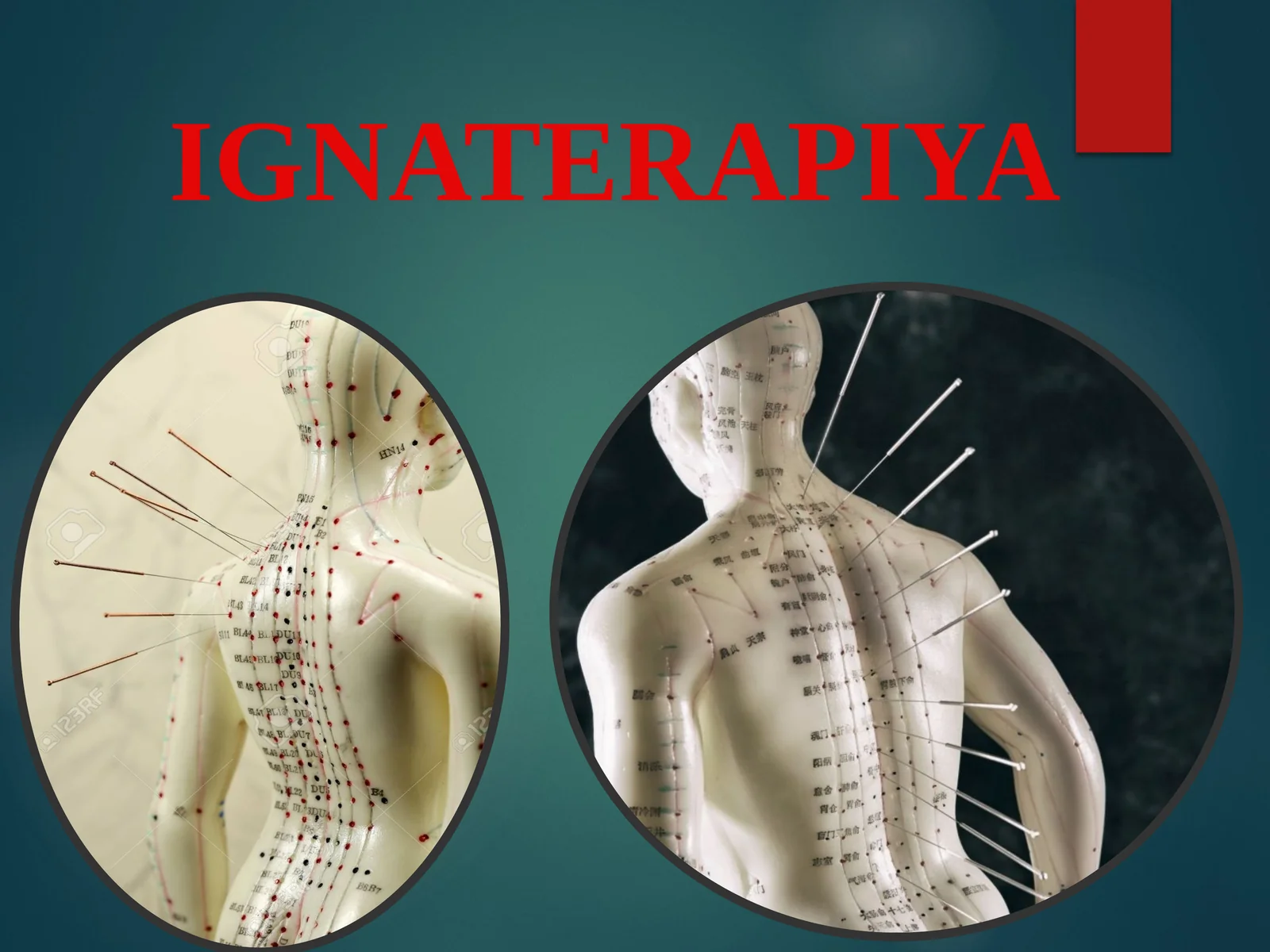 IGNATERAPIYA