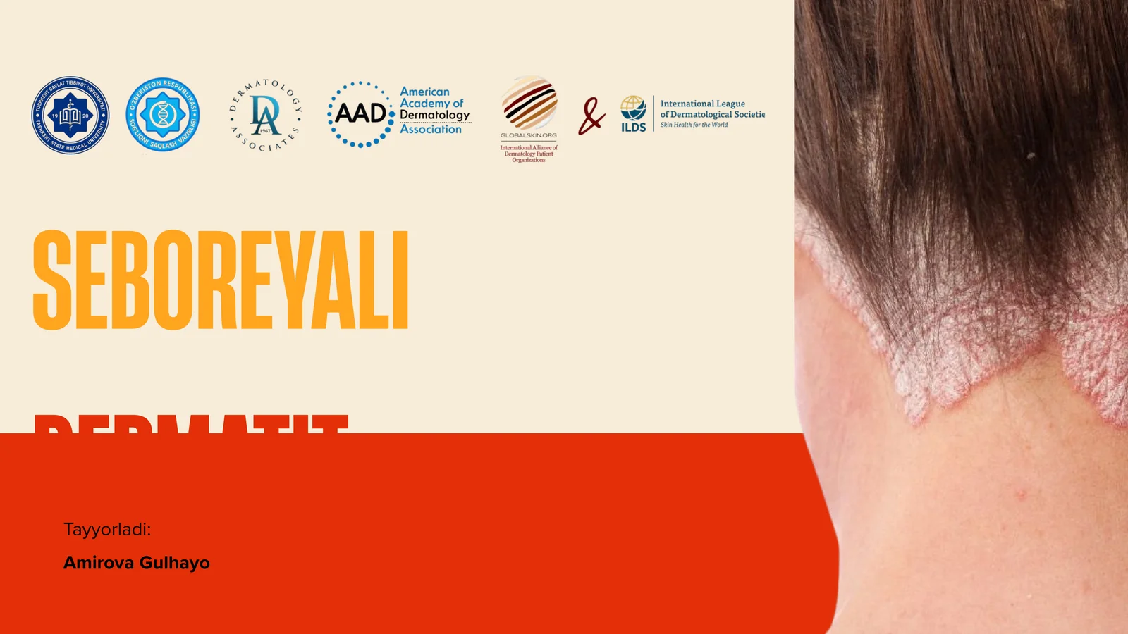 SEBOREYALIDERMATIT