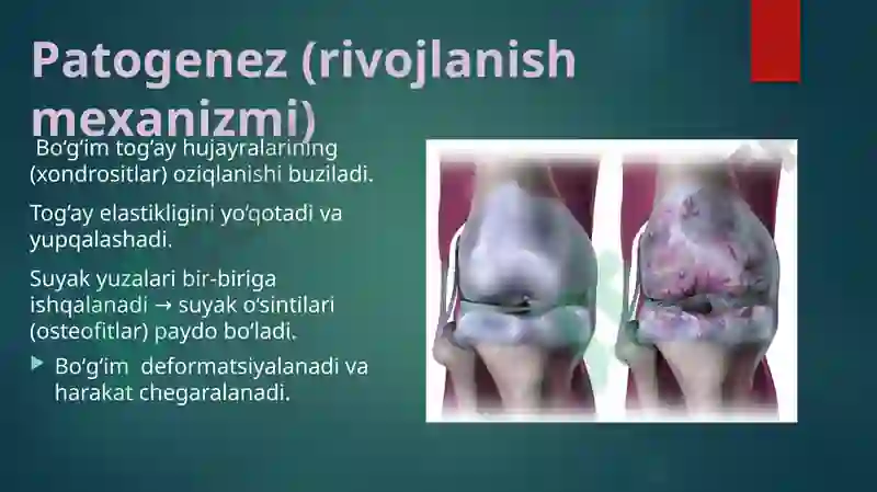 ARTROZ(OSTEOARTROZ)