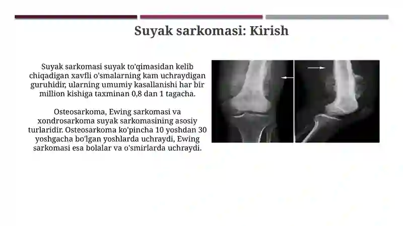 Suyak sarkomasi