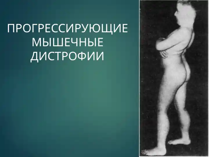 Прогрессирующие мышечные дистрофии