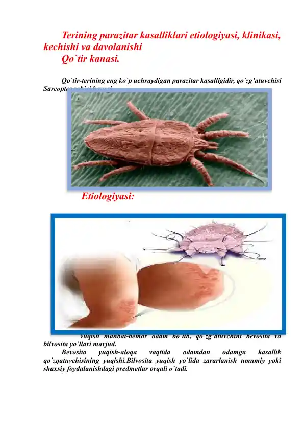 Teri qo`zg`atuvchisi (Qo`tir) parazitar kasalliklari etiologiyasi, klinikasi, kechishi va davolanishi
