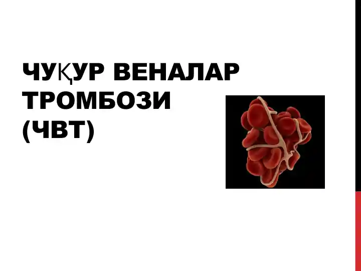 Чуқур веналар тромбози(чвт)