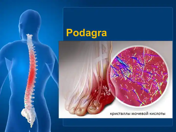 Podagra