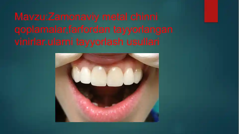 Zamonaviy metal chinni qoplamalar, farfordan tayyorlangan vinirlar, ularni tayyorlash usullari