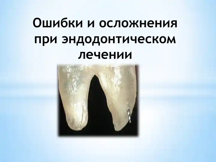 Ошибки и осложнения при эндодонтическом лечении
