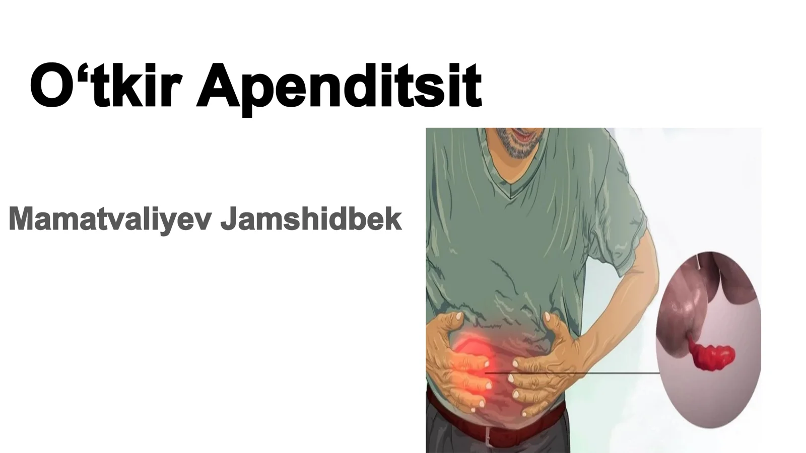 Oʻtkir Apenditsit