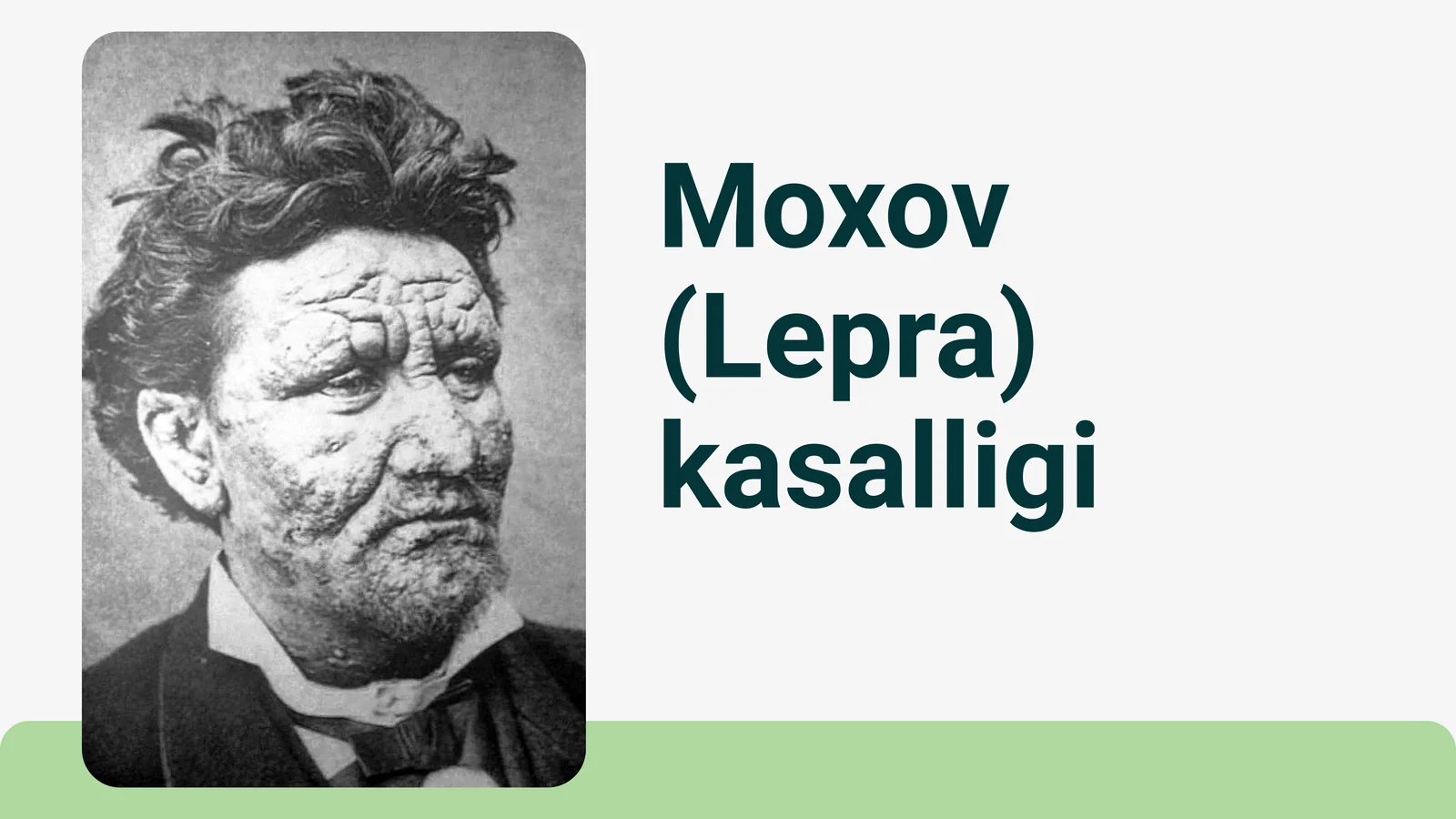 Mohov Lepra kasalligi