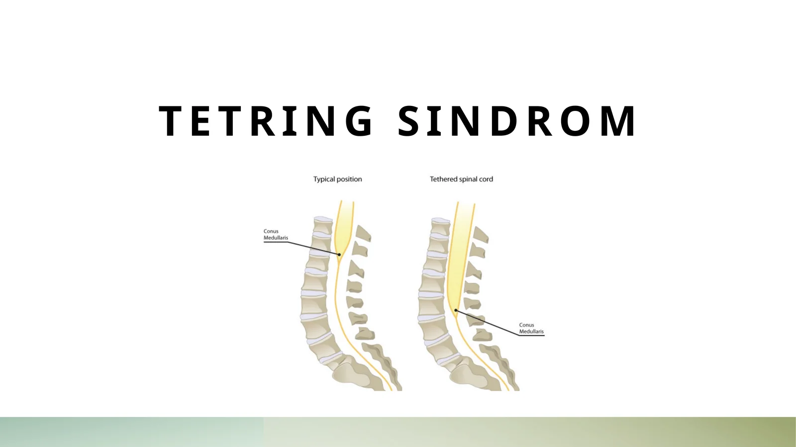 Tetring sindrom