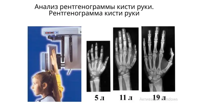 Рентгенограмма кисти руки