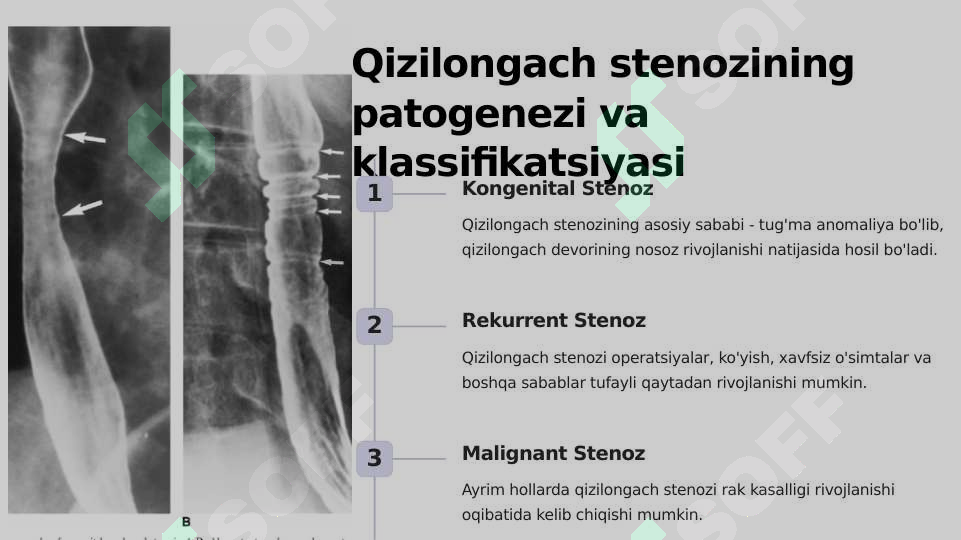 Qizilo ngach Stenozi Va Atreziyalarida Operatsiyalar Bolalarda Traxeya qizilo-ngach-stenozi-va-atreziyalarida-operatsiyalar-bolalarda-traxeya